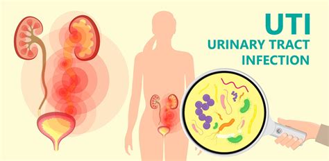 Urinary Tract Infections