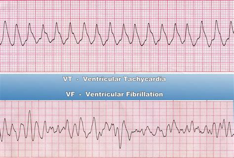 Ventricular Tachycardia EKG