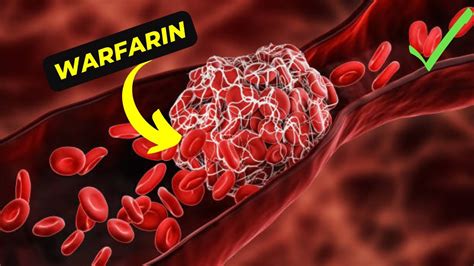 Warfarin Benefits